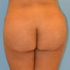 Back View - Brazilian Abdominoplasty Tummy Tuck surgery performed in Atlanta on a 34 year old patient mother of 1 child.