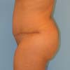 Left Side - Brazilian Abdominoplasty Tummy Tuck surgery, mommy makeover Atlanta, GA