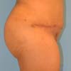 Right Side - Brazilian Abdominoplasty Tummy Tuck mommy makeover surgery in Atlanta, GA.