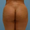 Brazilian Butt Lift at Bella Forma Cosmetic Surgery Center and Med Spa.