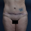 Brazilian Abdominoplasty Tummy Tuck surgery performed on 32 year old patient and three children.