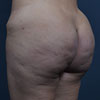 Brazilian tummy tuck performed in a 32 year old patient.