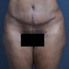Abdominoplasty, Tummy Tuck performed by Dr. Rajae Janho at Bella Forma Cosmetic Surgery Center, Lawrenceville, GA