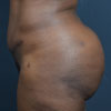Tummy Tuck, Abdominoplasty