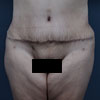 Abdominoplasty , Tummy Tuck