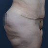 Tummy Tuck, Brazilian Abdominoplasty