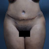 Abdominoplasty, Brazilian Tummy Tuck, performed by Doctor Rajae Janho at Bella Forma Cosmetic Surgery Center, Atlanta, GA
