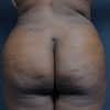 Brazilian Tummy Tuck, Abdominoplasty