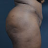Abdominoplasty, Brazilian Tummy Tuck