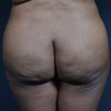 Abdominoplasty Tummy Tuck - Left Side - Performed by Doctor Rajae Janho at Bella Forma Cosmetic Surgery Center, Atlanta, GA