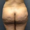 Abdominoplasty Tummy Tuck - Back- Performed by Doctor Rajae Janho at Bella Forma Cosmetic Surgery Center, Atlanta, GA