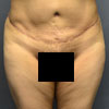 Abdominoplasty Tummy Tuck - Front - Performed by Doctor Rajae Janho at Bella Forma Cosmetic Surgery Center, Atlanta, GA