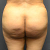 Abdominoplasty Tummy Tuck - Back - Performed by Doctor Rajae Janho at Bella Forma Cosmetic Surgery Center, Atlanta, GA