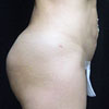Brazilian Butt Lift Surgery after 6 Months Post Op.