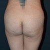 Abdominoplasty Tummy Tuck - Back - Performed by Doctor Rajae Janho at Bella Forma Cosmetic Surgery Center, Atlanta, GA