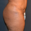 Abdominoplasty Tummy Tuck -Right Side - Performed by Doctor Rajae Janho at Bella Forma Cosmetic Surgery Center, Atlanta, GA