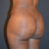 Abdominoplasty Tummy Tuck - Left Side - Performed by Doctor Rajae Janho at Bella Forma Cosmetic Surgery Center, Atlanta, GA