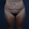 Abdominoplasty Tummy Tuck - Front - Performed by Doctor Rajae Janho at Bella Forma Cosmetic Surgery Center, Atlanta, GA