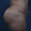 Abdominoplasty Tummy Tuck - Right Side - Performed by Doctor Rajae Janho at Bella Forma Cosmetic Surgery Center, Atlanta, GA