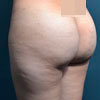 Brazilian Butt Lift performed by Doctor Rajae Janho at Bella Forma Cosmetic Surgery Center