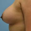 Atlanta Breast augmentation is for women who have one breast that is noticeably smaller than the other.