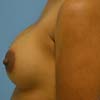 Our breast implants done at Bella Forma Atlanta allows you to obtain a youthful feminine shape.