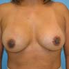 Dr. Rajae Janho offer breast augmentation surgery from their practice, Bella Forma Cosmetic Surgery and Med Spa Center.