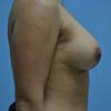 Breast Augmentation Implants at performed by Dr. Rajae Janho.