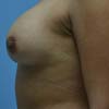 Breast Augmentation Implants at Bella Forma Cosmetic Surgery and Med Spa Center Atlanta, GA.