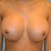 Breast implants in Atlanta at Bella Forma Cosmetic Surgery and Med Spa Center.