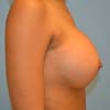 Breast implants in Atlanta by Dr. Rajae Janho.