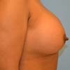 Breast Augmentation on a 29 years old patient no children.
