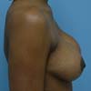 Breast Augmentation performed on 38 years old patient mother of two.