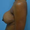 Breast Augmentation surgery performed on 38 years old patient mother of two.