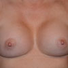 View before and after photos of breast augmentation results performed Atlanta GA cosmetic surgeon, Dr. Rajae Janho.