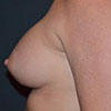 View before and after photos of breast augmentation results performed Atlanta GA cosmetic surgeon, Dr. Rajae Janho.