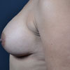 View before and after photos of breast augmentation results performed Atlanta GA cosmetic surgeon, Dr. Rajae Janho.