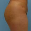 Brazilian Butt Lift surgery performed at Bella Forma Cosmetic Surgery and Med Spa in Atlanta, GA.