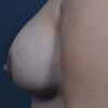 View before and after photos of breast augmentation results performed Atlanta GA cosmetic surgeon, Dr. Rajae Janho.