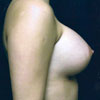 Breast Augmentation - Right Side - Performed by Doctor Rajae Janho at Bella Forma Cosmetic Surgery Center, Atlanta, GA