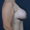 Breast Augmentation - Right Side - Performed by Doctor Rajae Janho at Bella Forma Cosmetic Surgery Center, Atlanta, GA