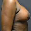 Breast Augmentation - Right Side - Performed by Doctor Rajae Janho at Bella Forma Cosmetic Surgery Center, Atlanta, GA