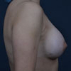 Breast Augmentation - Right Side - Performed by Doctor Rajae Janho at Bella Forma Cosmetic Surgery Center, Atlanta, GA