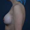 Breast Augmentation - Left Side - Performed by Doctor Rajae Janho at Bella Forma Cosmetic Surgery Center, Atlanta, GA