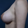 Breast Augmentation - Left Side - Performed by Doctor Rajae Janho at Bella Forma Cosmetic Surgery Center, Atlanta, GA