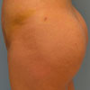 Buttock augmentation and buttock repair include the surgical emplacement of a gluteal implant buttock prosthesis.