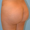 Consider Buttock Augmentation If clothes and swimwear do not fit properly on your figure.