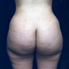 Brazilian Butt Lift performed by Doctor Rajae Janho at Bella Forma Cosmetic Surgery Center