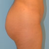 Gluteal implants in Atlanta is a method for enlarging and reshaping your buttocks.
