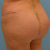 In Atlanta, gluteal augmentation, buttock augmentation or gluteal solid implants are performed at Bella Forma Cosmetic Surgery Center.